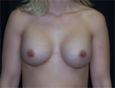 Patient # 60794 After Photo # 2