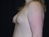 Patient # 24880 Before Photo # 3