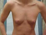 Patient # 12074 Before Photo # 1