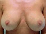 Patient # 25255 After Photo # 2