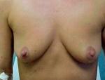 Patient # 25255 Before Photo # 1