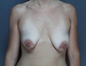 Patient # 54385 Before Photo # 1