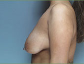 Patient # 97146 Before Photo # 1