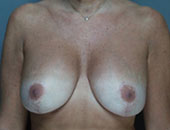 Patient # 40949 After Photo # 2