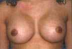 Patient # 30421 After Photo # 2