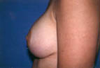 Patient # 46092 After Photo # 2