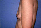 Patient # 46092 Before Photo # 1