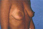 Patient # 24306 Before Photo # 1