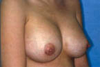 Patient # 67937 After Photo # 2