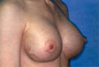 Patient # 58333 After Photo # 2