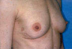 Patient # 58333 Before Photo # 1