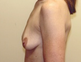 Patient # 65499 Before Photo # 5