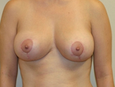 Patient # 44745 After Photo # 2