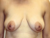 Patient # 77429 Before Photo # 1