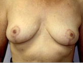 Patient # 23911 After Photo # 2