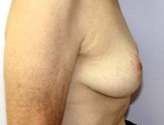 Patient # 23911 After Photo # 4