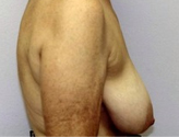 Patient # 23911 Before Photo # 3