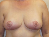 Patient # 16381 After Photo # 2