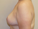 Patient # 16381 After Photo # 4
