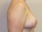 Patient # 16381 After Photo # 6
