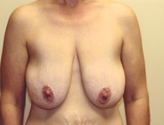 Patient # 16381 Before Photo # 1