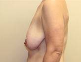 Patient # 16381 Before Photo # 3