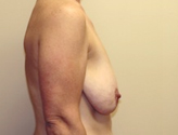 Patient # 16381 Before Photo # 5