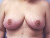 Patient # 63944 After Photo # 2