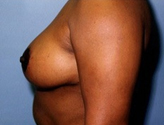 Patient # 30894 After Photo # 4