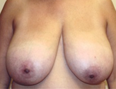 Patient # 31534 Before Photo # 1