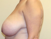 Patient # 31534 Before Photo # 3