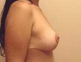 Patient # 20603 After Photo # 6