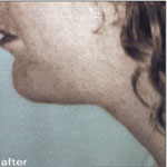 Patient # 13406 After Photo # 2
