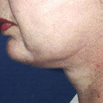 Patient # 18319 After Photo # 2