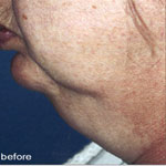 Patient # 18319 Before Photo # 1