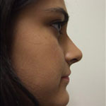 Patient # 85939 After Photo # 4