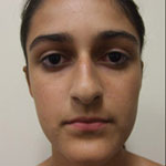 Patient # 85939 Before Photo # 1