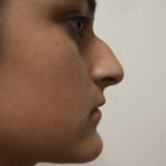 Patient # 85939 Before Photo # 3