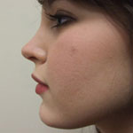 Patient # 38519 After Photo # 4