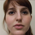 Patient # 38519 Before Photo # 1