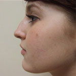 Patient # 38519 Before Photo # 3