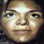 Patient # 80916 Before Photo # 1