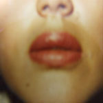 Patient # 82372 After Photo # 2