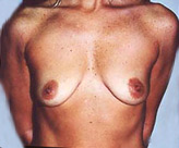 Patient # 38163 Before Photo # 1