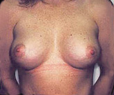 Patient # 93794 After Photo # 2