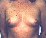 Patient # 93794 Before Photo # 1