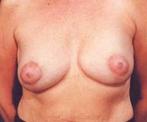 Patient # 48367 After Photo # 2