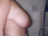 Patient # 65113 Before Photo # 3