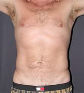 Patient # 51806 After Photo # 2
