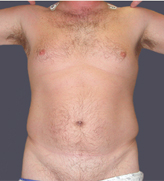 Patient # 51806 Before Photo # 1